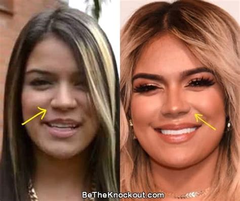 karol g nose job|Karol G Before And After Surgery